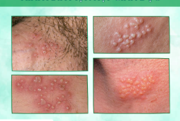 noi-mun-o-duong-vat-la-benh-gi-tim-hieu-ngay-voi-chuyen-gia