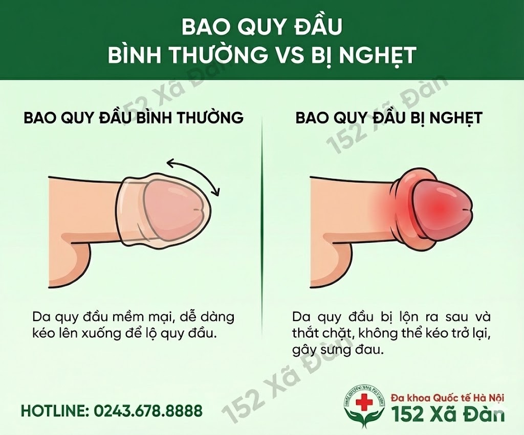 nghet-bao-quy-dau-la-gi-nguyen-nhan-dau-hieu-va-cach-dieu-tri-hieu-qua