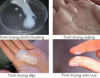 Vì Sao Tinh Trùng Bị Vón Cục? Có Ảnh Hưởng Khả Năng Sinh Sản Không?